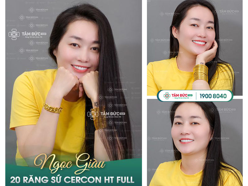 chị Ngọc Giàu bọc răng sứ tại nha khoa Tâm Đức Smile