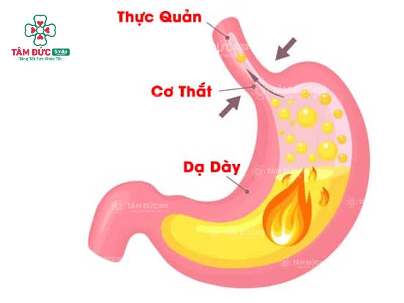 buồn nôn khi đánh răng là do bệnh lý trào ngược dạ dày