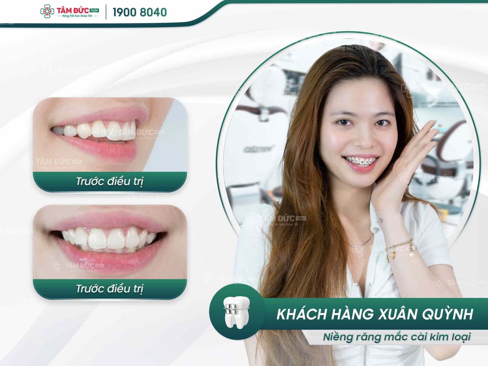 các giai đoạn niềng răng hô