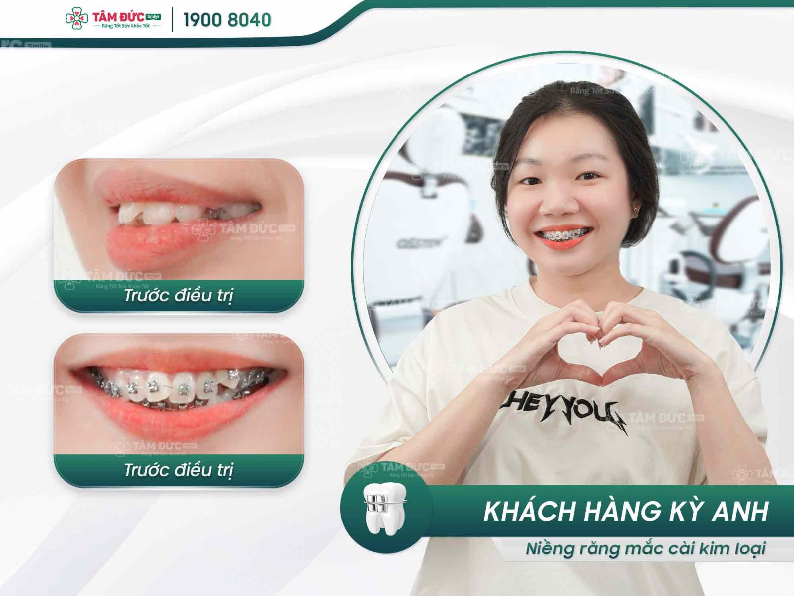 khách hàng niềng răng hô tại nha khoa tâm đức smile