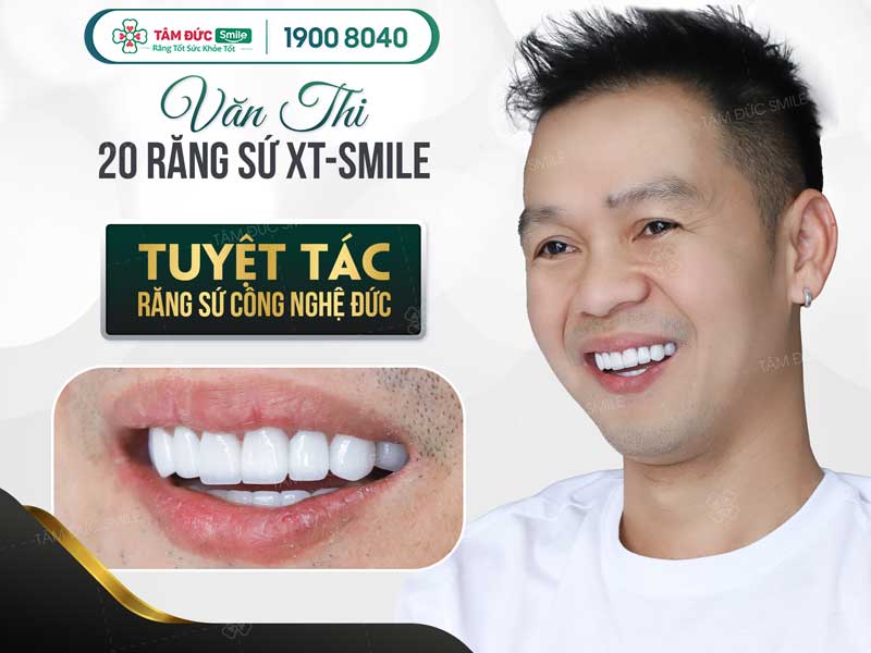 các loại răng sứ phổ biến