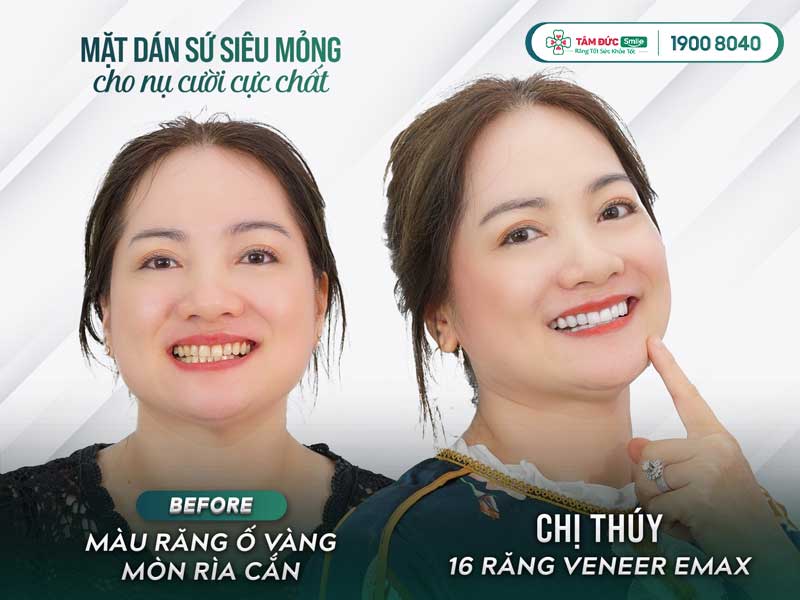 các loại răng sứ phổ biến