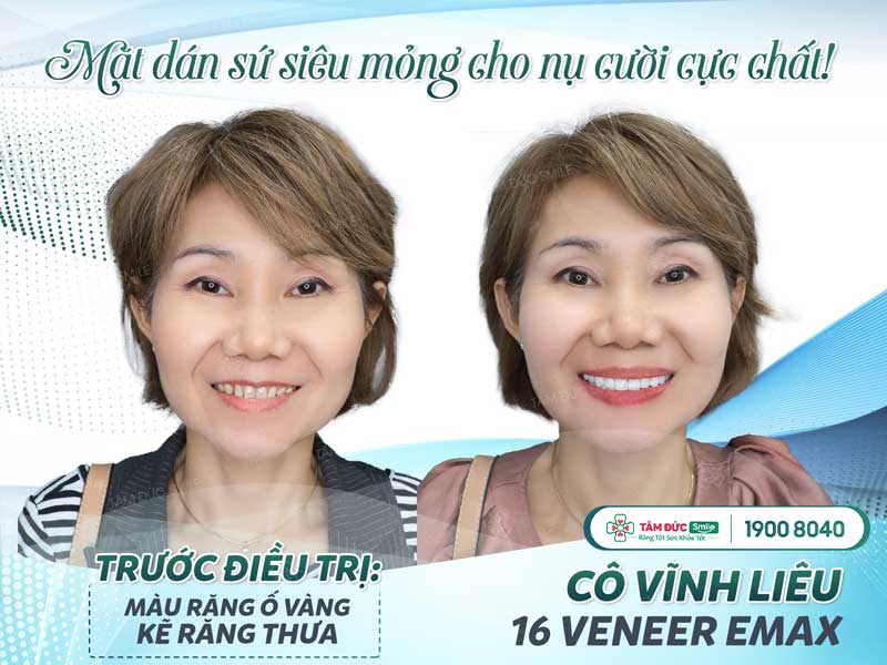 các loại răng sứ phổ biến