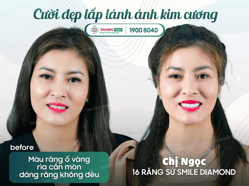 các loại răng sứ phổ biến