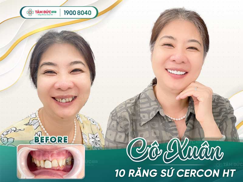 các loại răng sứ phổ biến