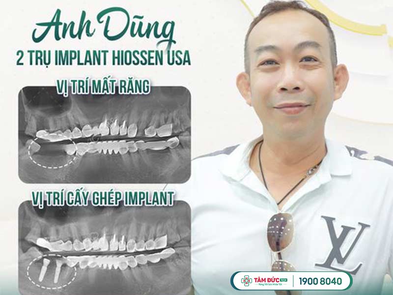 anh Dũng sau khi cấy ghép Implant tại nha khoa Tâm Đức Smile