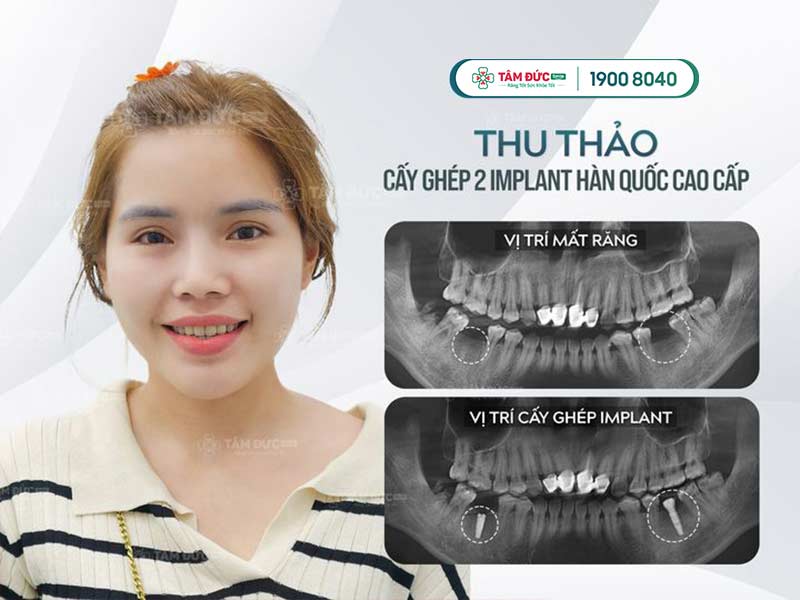 cách chăm sóc sau khi cấy ghép Implant tại nha khoa Tâm Đức Smile