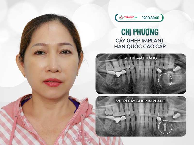 cách chăm sóc sau khi cấy ghép Implant