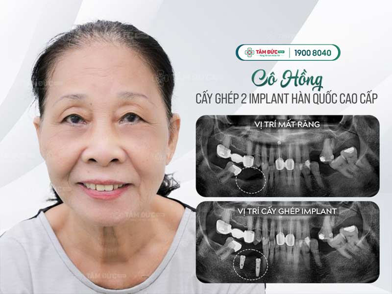 cô Hồng sau khi cấy ghép Implant tại nha khoa Tâm Đức Smile