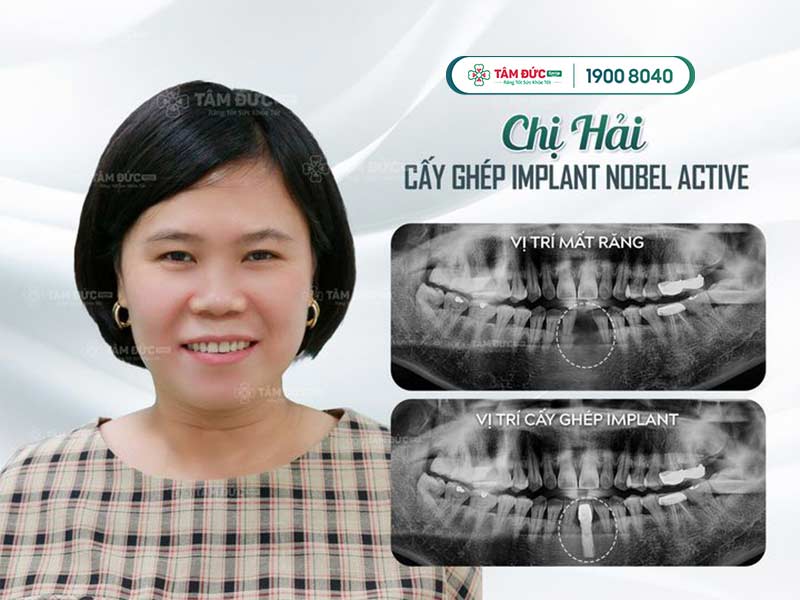 cách chăm sóc sau khi cấy ghép implant