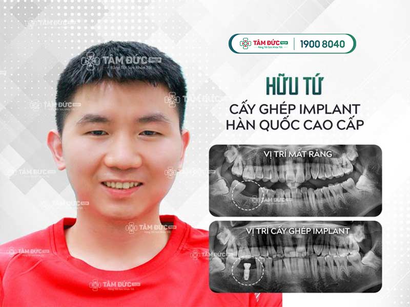 cách chăm sóc sau khi cấy ghép Implant tại nha khoa Tâm Đức Smile