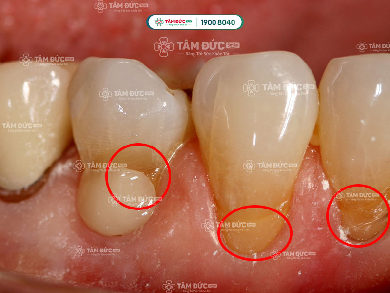 lộ ngà răng làm tăng nguy cơ bị sâu răng