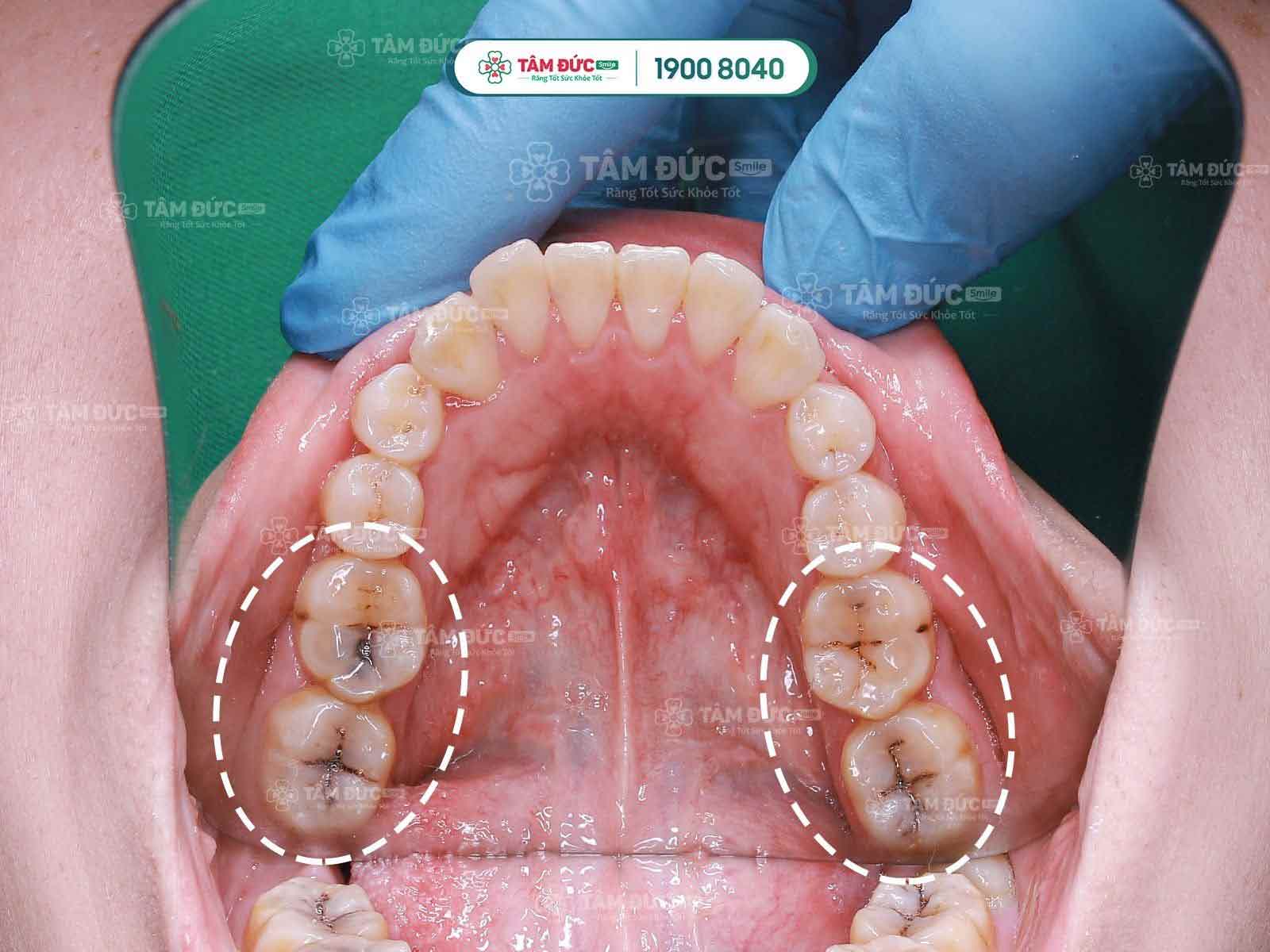 cách chữa răng ê buốt tại nhà