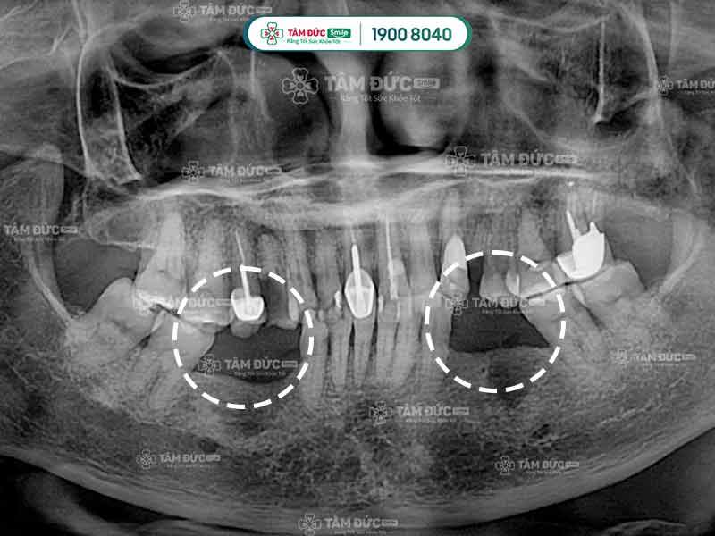 phim x-quang bị mất răng