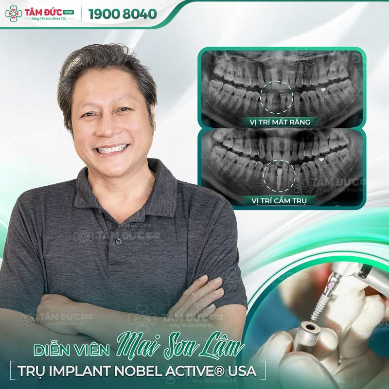 diễn viên Mai Sơn Lâm cấy ghép Implant tại nha khoa Tâm Đức Smile