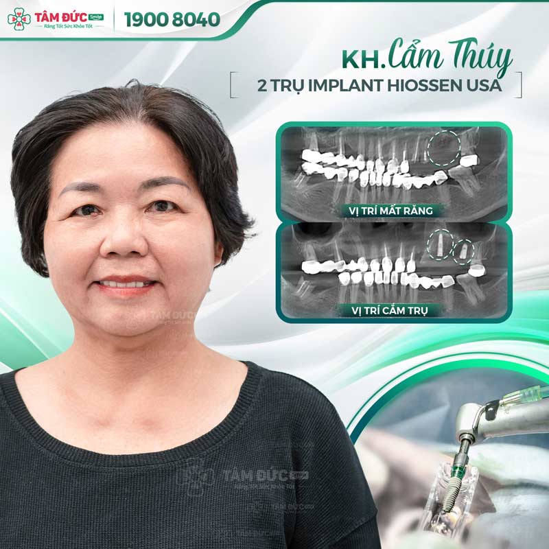 cô Cẩm Thuý cấy ghép Implant tại nha khoa Tâm Đức Smile