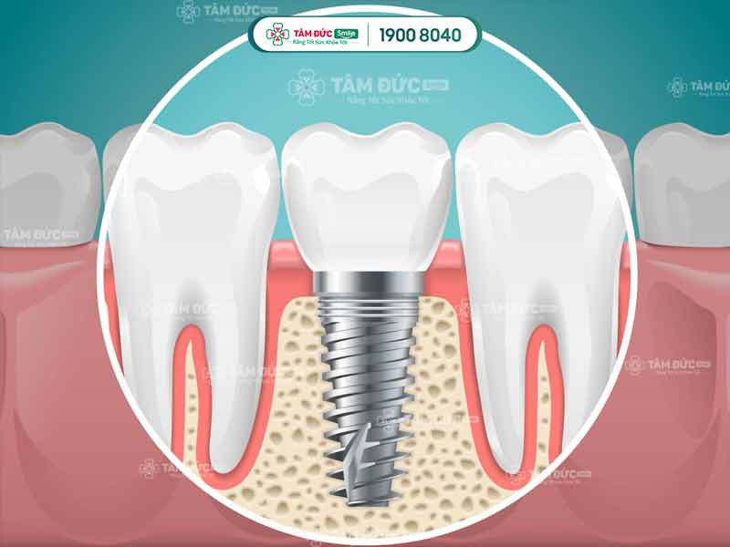 răng Implant ở trong khuôn hàm