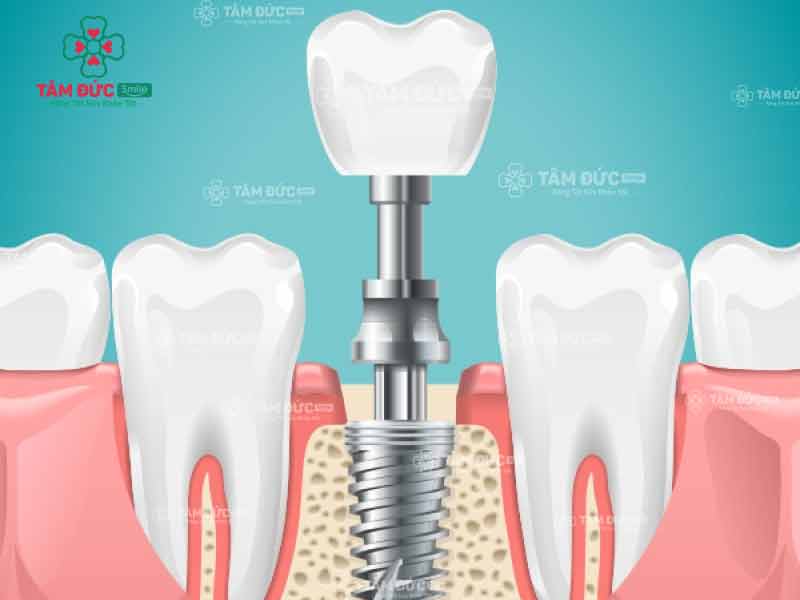 trồng răng implant vào xương hàm