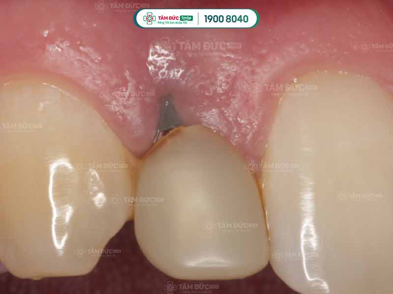 dấu hiệu trụ Implant bị đào thải