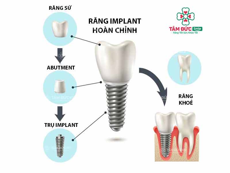 cấu tạo các thành phần của răng implant