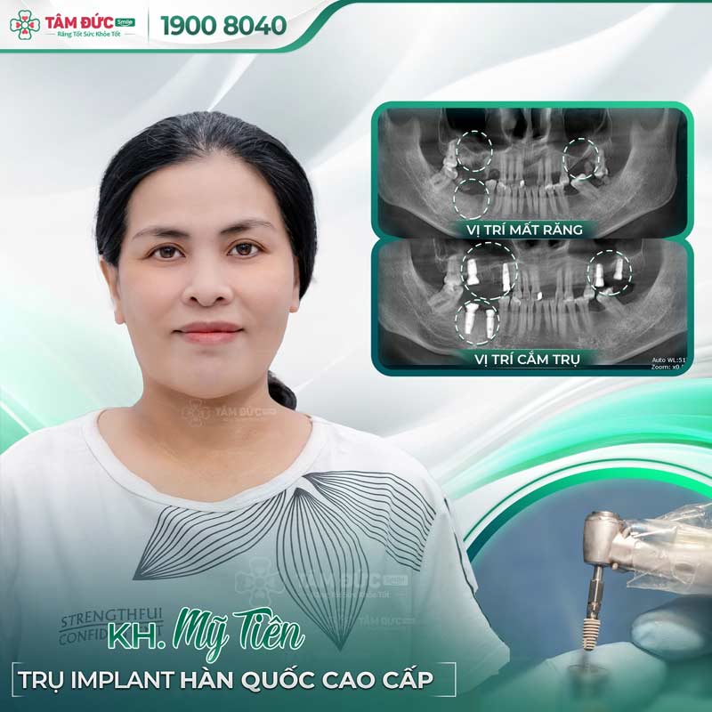 khách hàng trồng răng tại nha khoa Tâm Đức Smile