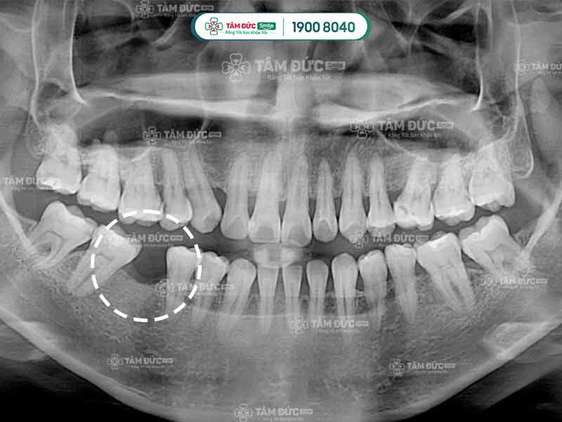 phim x-quang bị mất răng