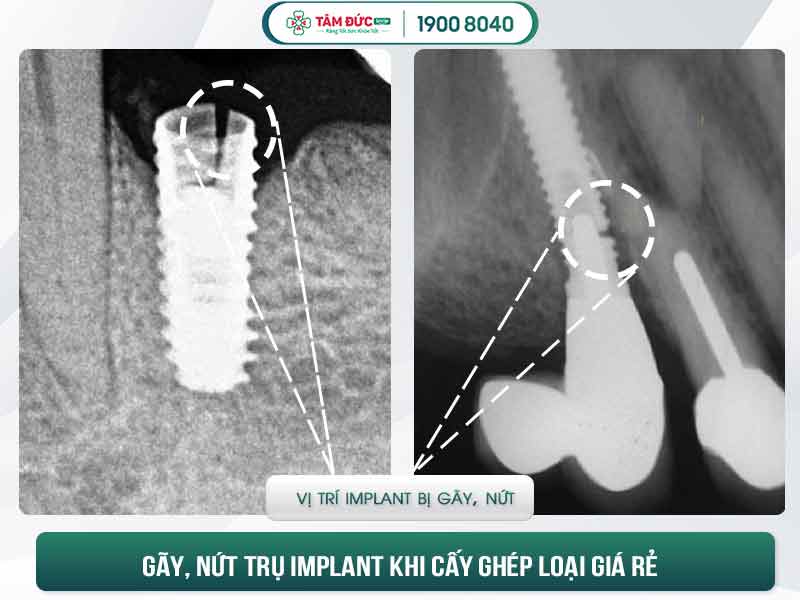 implant giá rẻ hối hận 1 đời