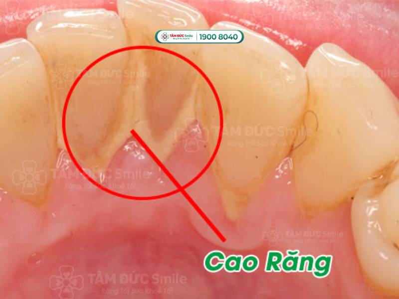 Cao răng gây hôi miệng có chữa được không