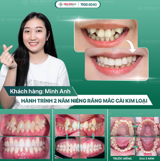 cắt kẽ răng trước và sau khi niềng