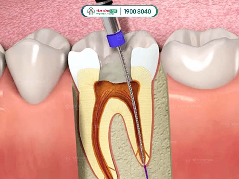 quy trình điều trị tuỷ