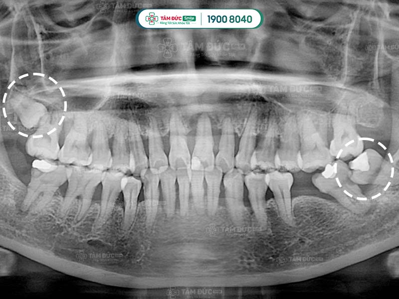 phim x-quang răng khôn mọc lệch