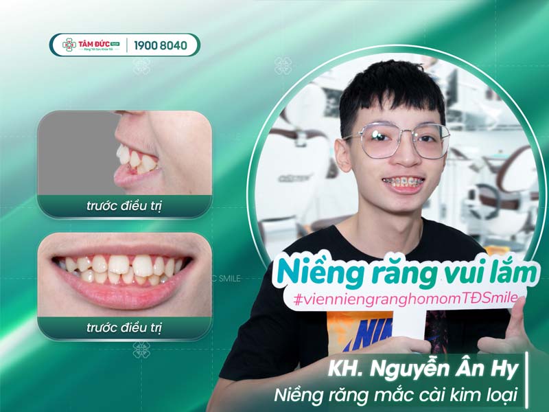 khách hàng niềng răng trong suốt tại nha khoa Tâm Đức Smile