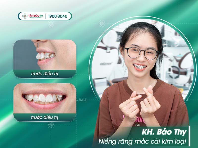 khách hàng niềng răng trong suốt tại nha khoa Tâm Đức Smile