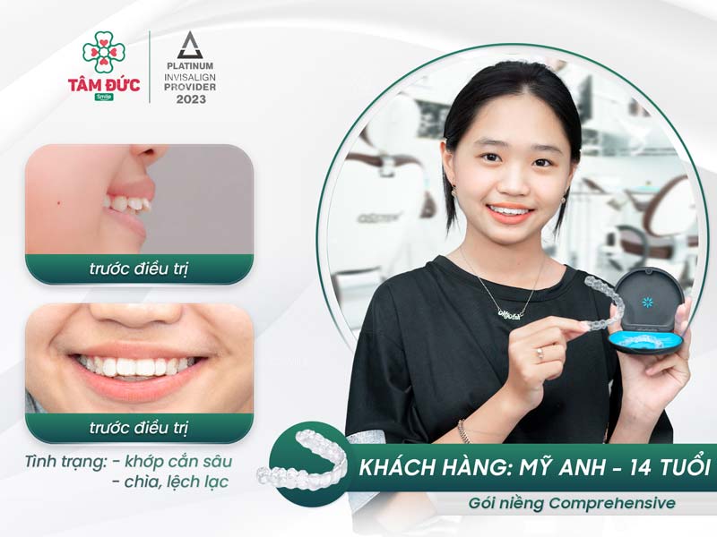 khách hàng niềng răng trong suốt tại nha khoa Tâm Đức Smile