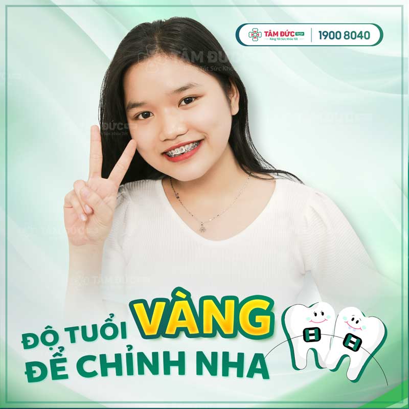 độ tuổi vàng niềng răng