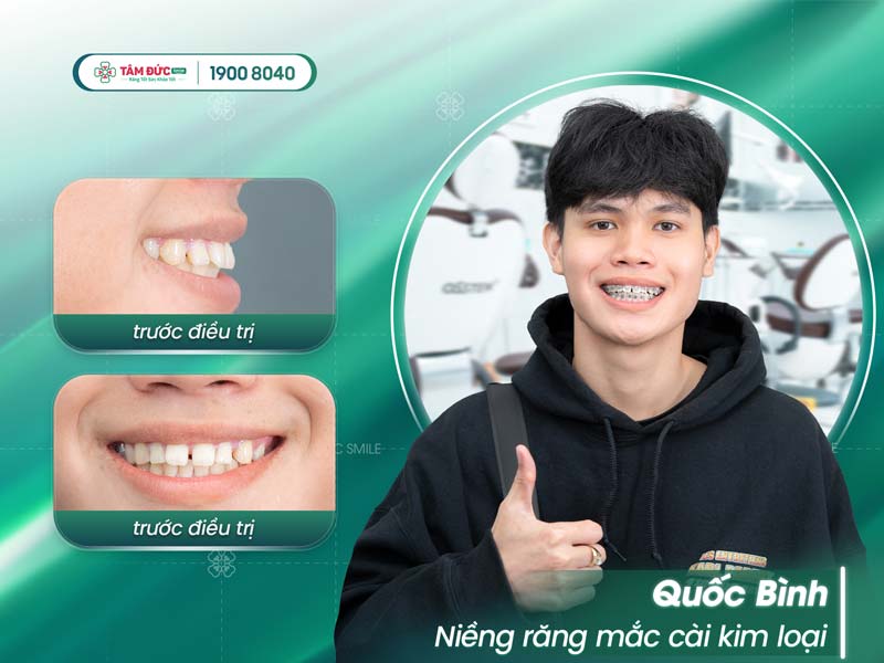 khách hàng niềng răng trong suốt tại nha khoa Tâm Đức Smile