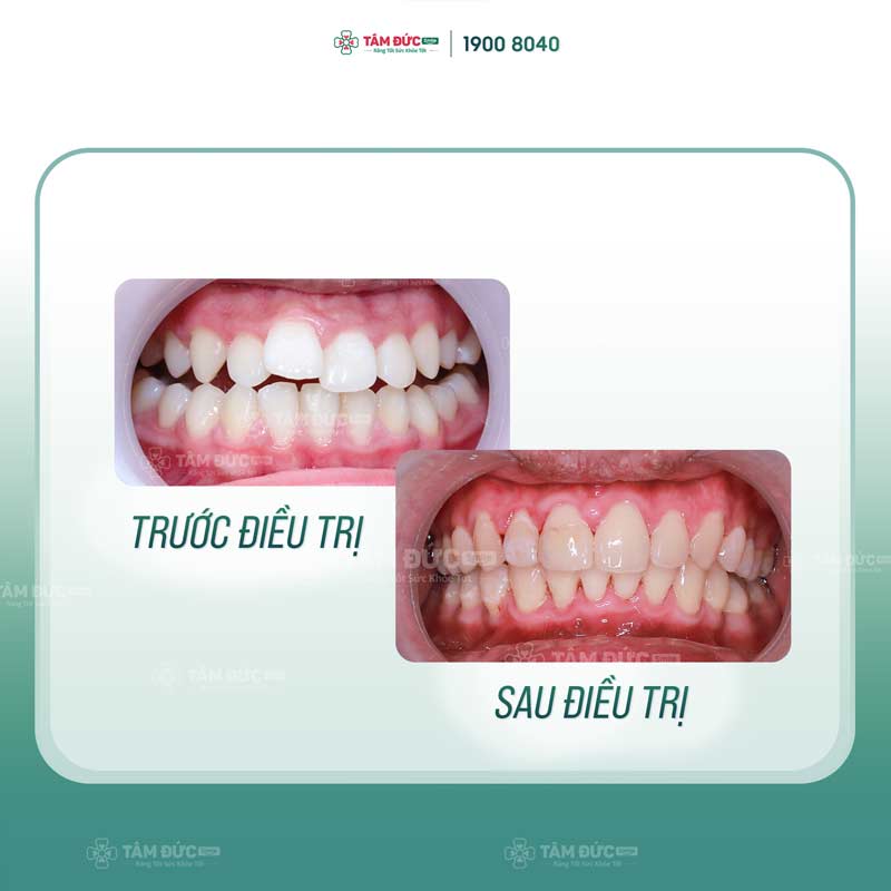 trước và sau khi niểng răng tại nha khoa Tâm Đức Smile