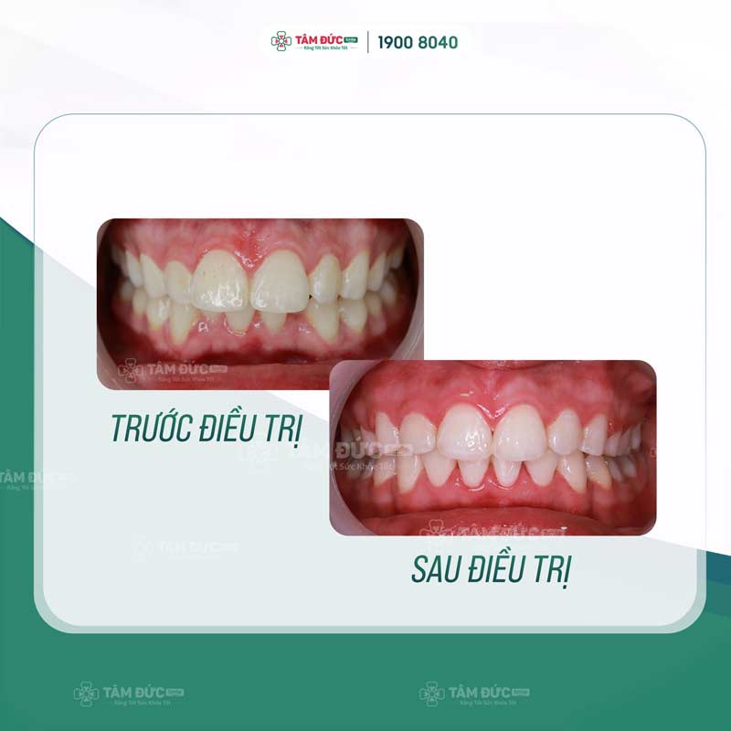 trước và sau khi niểng răng tại nha khoa Tâm Đức Smile