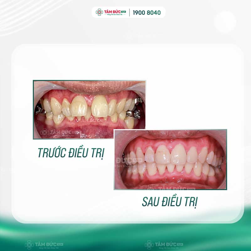 trước và sau khi niểng răng tại nha khoa Tâm Đức Smile