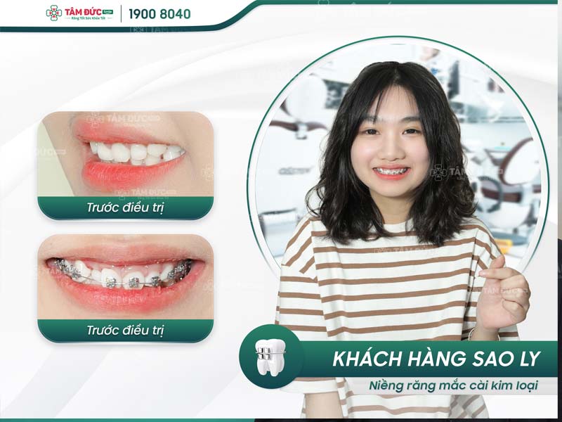 khách hàng niềng răng mắc cài tại nha khoa Tâm Đức Smile