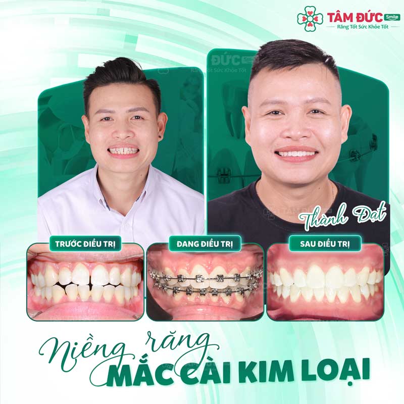 khách hàng trước và sau khi niềng răng tại nha khoa Tâm Đức Smile