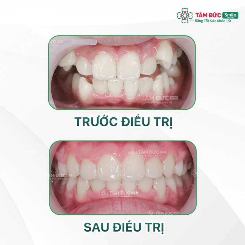 khách hàng trước và sau khi niềng răng tại nha khoa Tâm Đức Smile