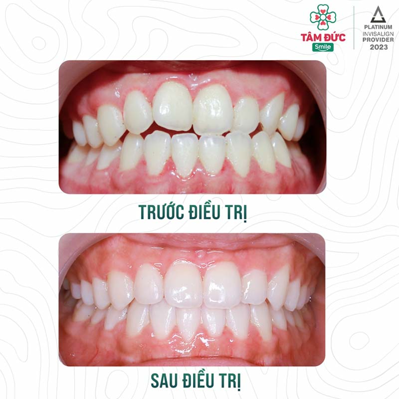 trước và sau khi niềng răng khớp cắn đối đầu