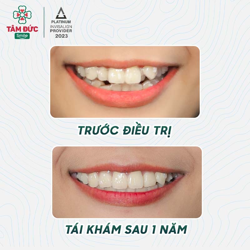 trước và sau khi niềng răng khấp khểnh