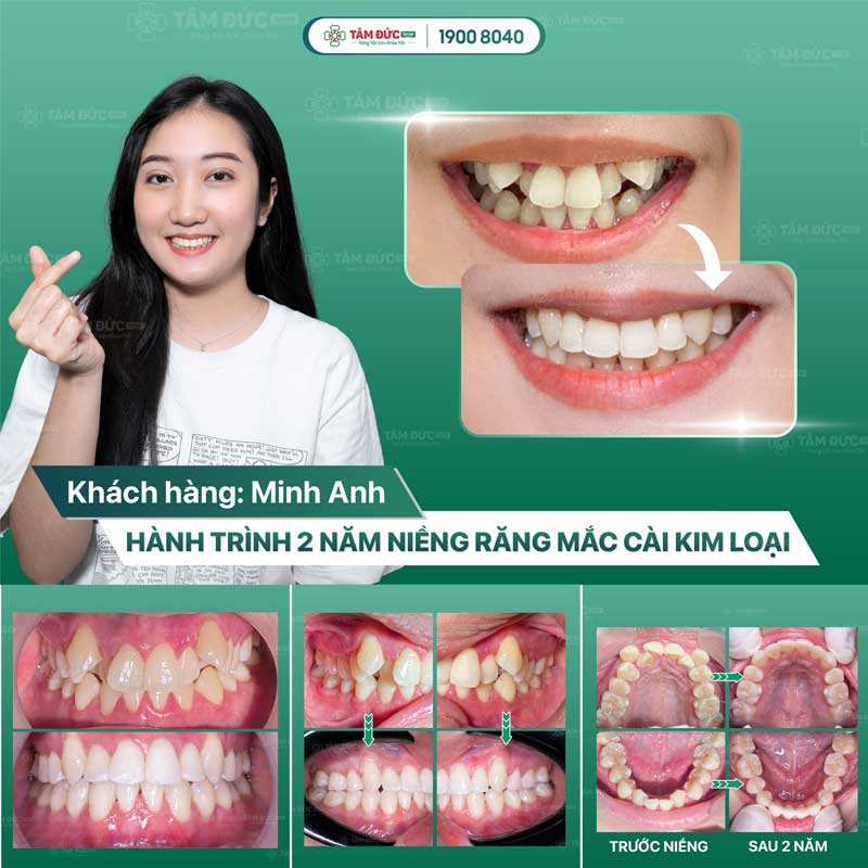 các trường hợp Quý khách nên niềng răng