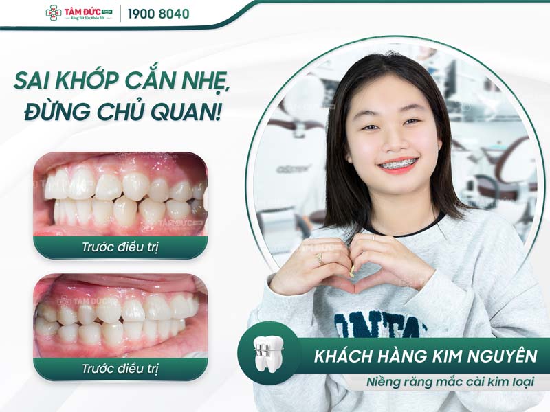 khách hàng niềng răng mắc cài tại nha khoa Tâm Đức Smile