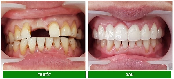Bọc răng sứ Titan có bị đen không và cách khắc phục như thế nào?