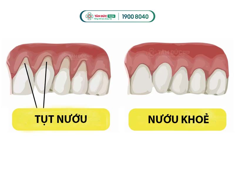 phân biệt nướu khoẻ mạnh và nướu bị bệnh