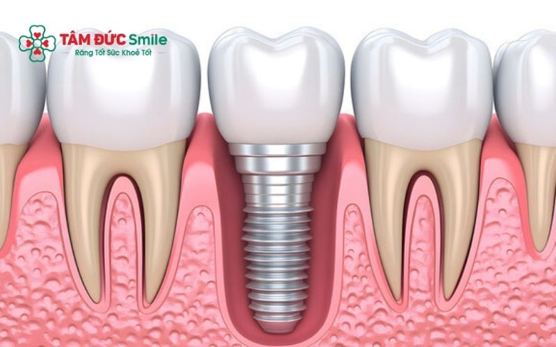 cay-ghep-implant-hai-chau-1