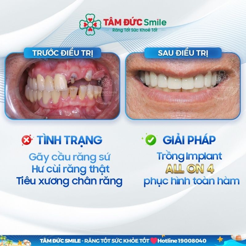 cay-ghep-implant-hai-chau-2
